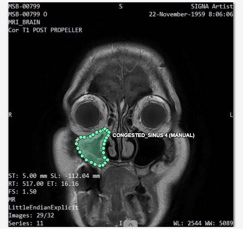 MRI axial scan with congested sinus annotation